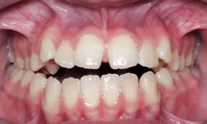 Caso Aline — antes do implante unitário