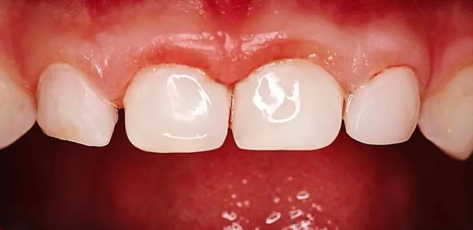 Caso Fernanda — depois do tratamento odontopediátrico