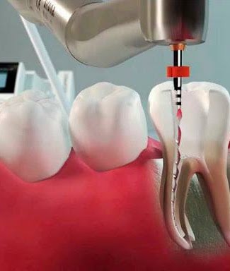 Endodontia – tratamento de canal ilustrado