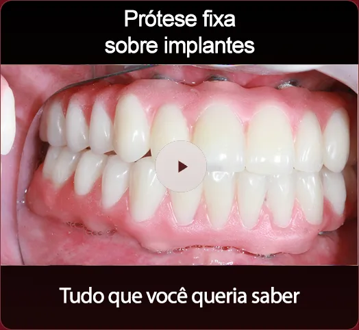 Implantes dentários parciais na Tonon Odontologia