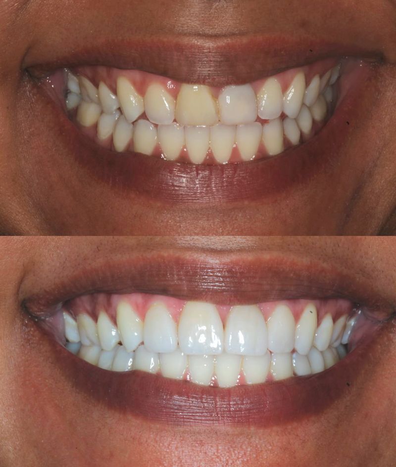 Ortodontia – exemplo de sorriso alinhado