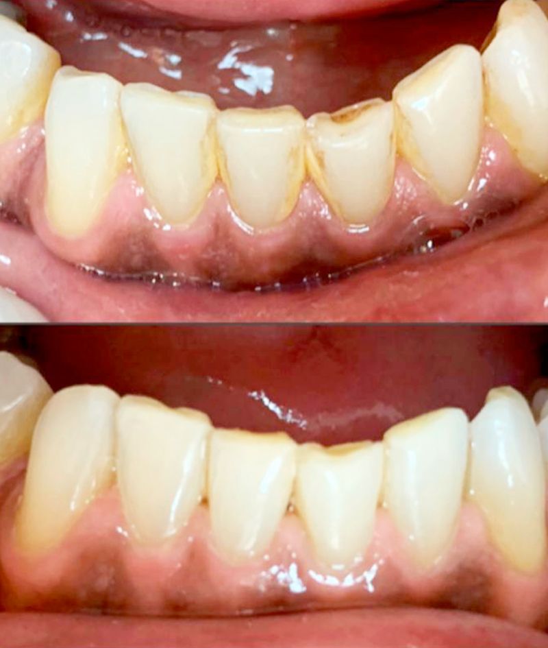 Periodontia – antes e depois de tratamento periodontal