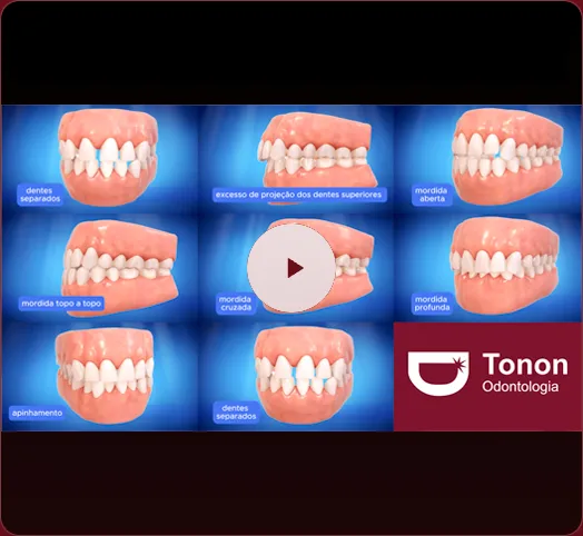 Vídeo explicativo sobre as opções de aparelho